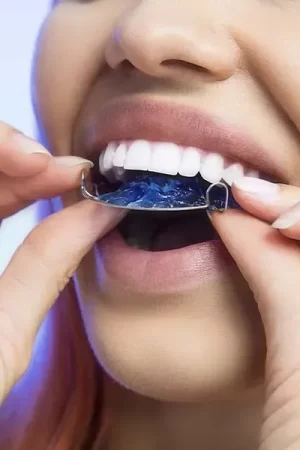 Dental Retainers