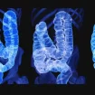 Malignant growth in the Colon – Watch it now