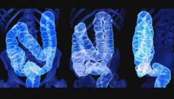 Malignant growth in the Colon – Watch it now