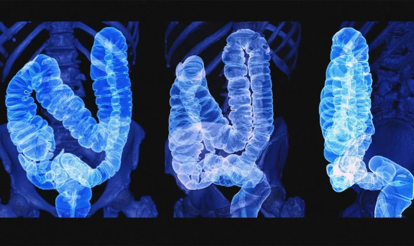 Malignant growth in the Colon – Watch it now