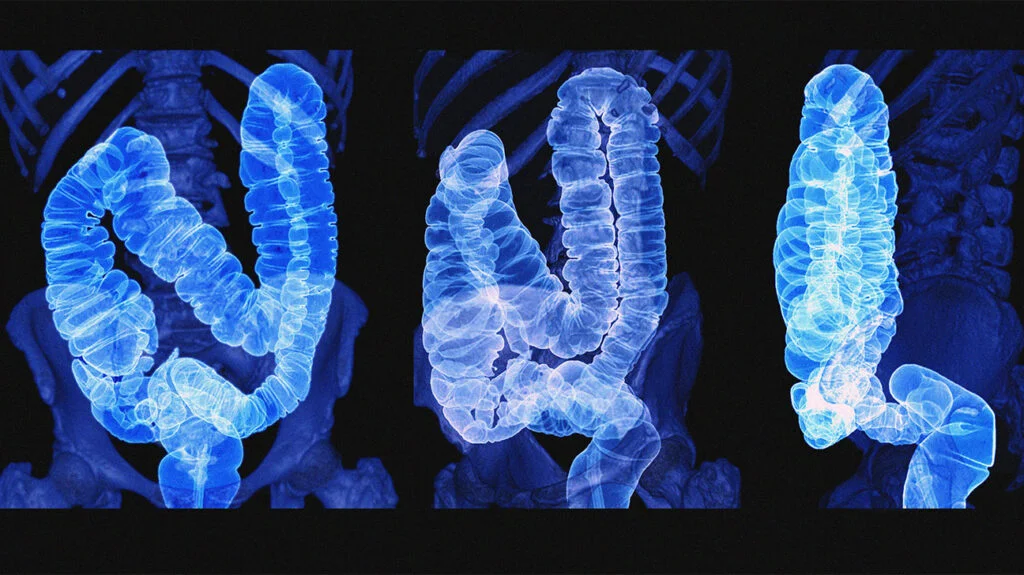 Malignant growth in the Colon – Watch it now