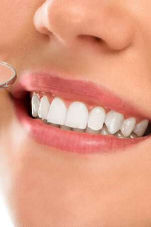 dental veneers